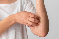 Atopowe zapalenie skóry: kompleksowy przewodnik po objawach i leczeniu