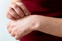 Jak naturalnie łagodzić objawy atopowego zapalenia skóry?