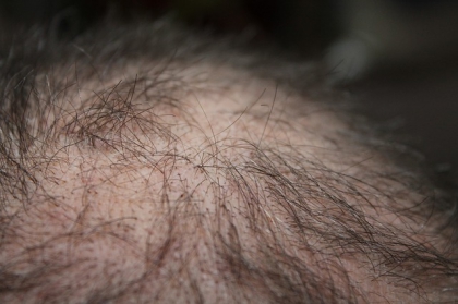 Osocze bogatopłytkowe w leczeniu łysienia