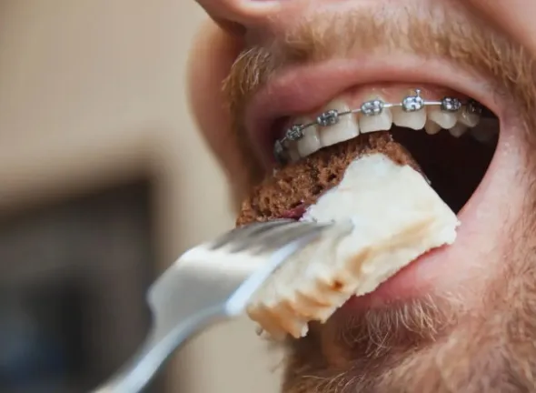 Jak usuwać osad powstający wokół zamków ortodontycznych?